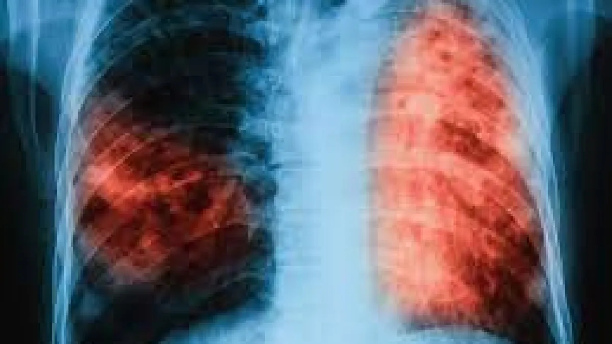 Aumentan los casos de tuberculosis en Córdoba