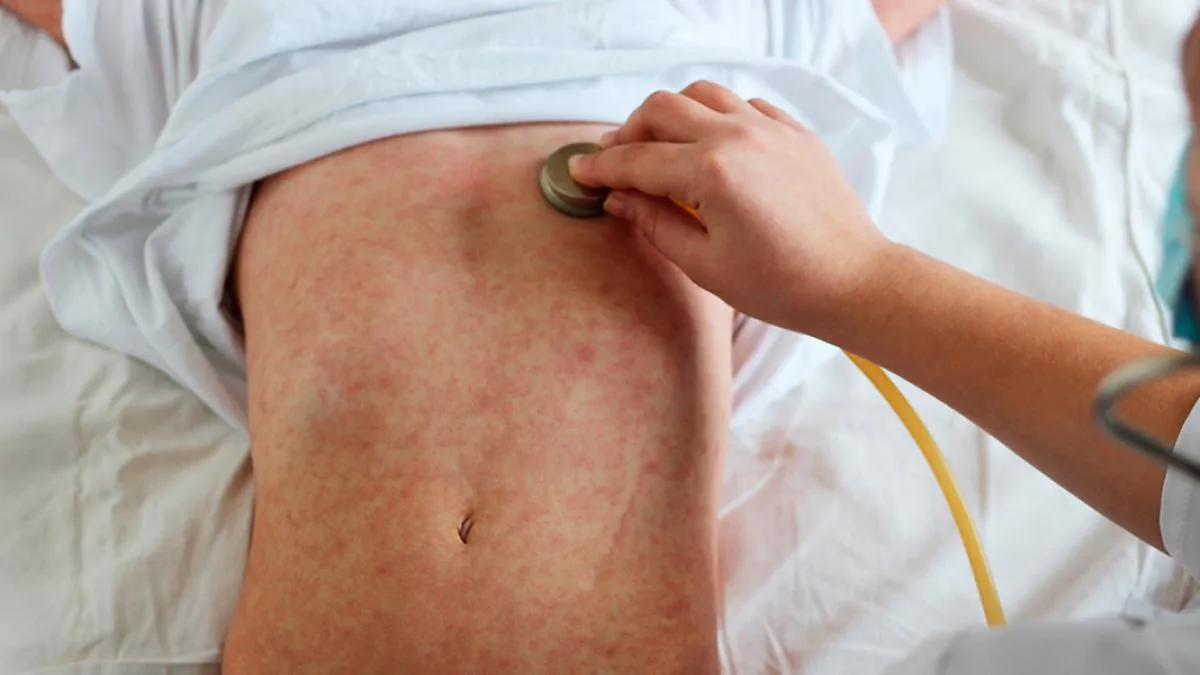 Alerta por dos nuevos casos de sarampión en el país
