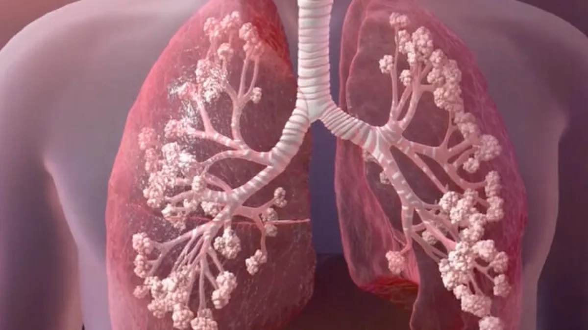 El 8 de septiembre es el Día Mundial de la Fibrosis Quística