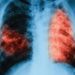 Aumentan los casos de tuberculosis en Córdoba