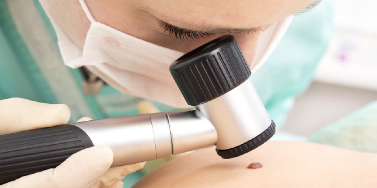 Llega la campaña "Salva tu piel" para control de lunares