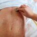 Alerta por dos nuevos casos de sarampión en el país