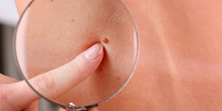 23 de Mayo: Día Mundial contra el Melanoma